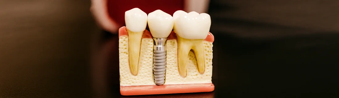 FC – Dental Implant Treatment at Roger Gibbon DDS in Lancaster PA
